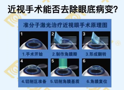 近视手术能否去除眼底病变？