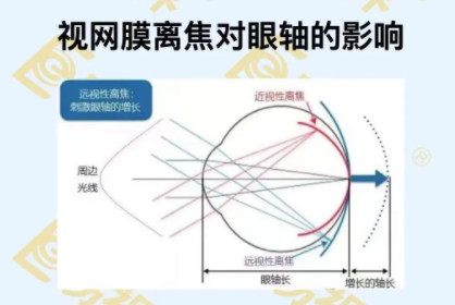 视网膜离焦对眼轴的影响