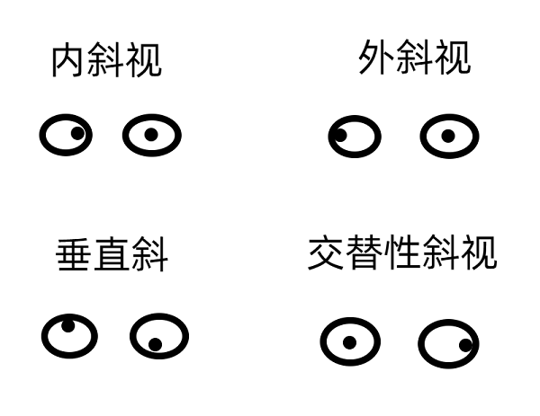 隐斜视相关知识